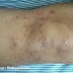 Sueurs nocturnes fortes et éruptions cutanées – c’est comment lymphome