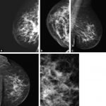 Cancer inflammatoire du sein : ces signes indiquent une tumeur